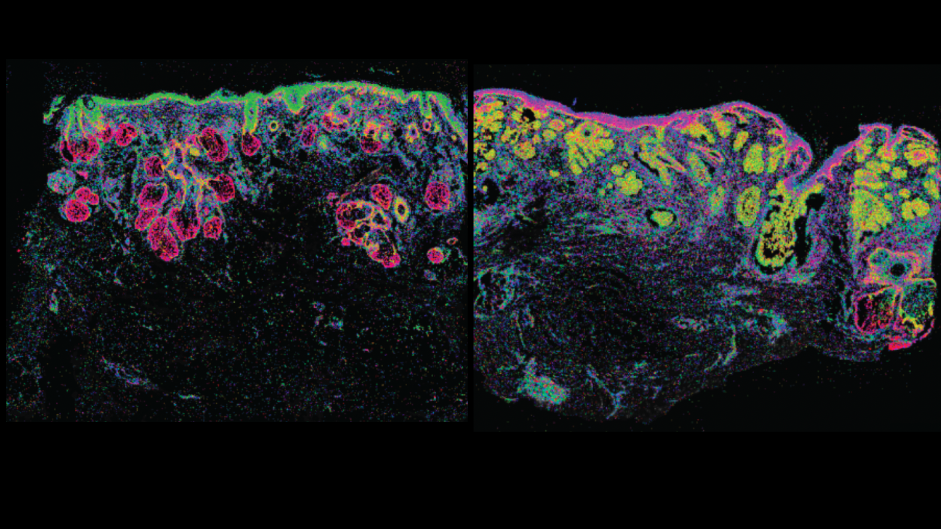 Spatial transcriptomics of Basal Cell Carcinoma